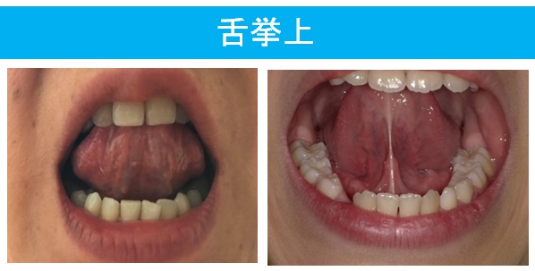 舌を上顎につけた時の良くない状態を示す写真