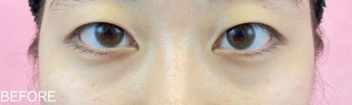 二重整形埋没法の患者のビフォー