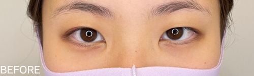 二重整形埋没法の患者のビフォー