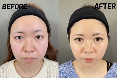 リフトアップ施術を行った女性
