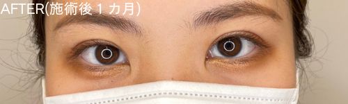二重整形埋没法の患者のアフター