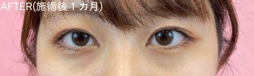 二重整形埋没法の患者のアフター