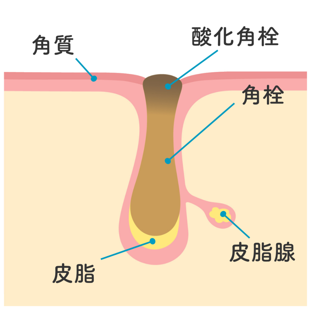 角栓を表す図