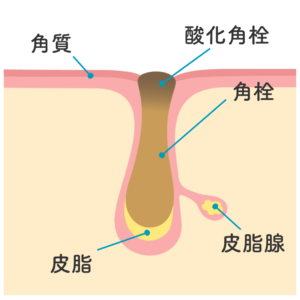 角栓を表す図