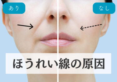 左右でほうれい線の目立ちが変わる女性