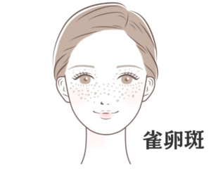 ソバカスのイラスト