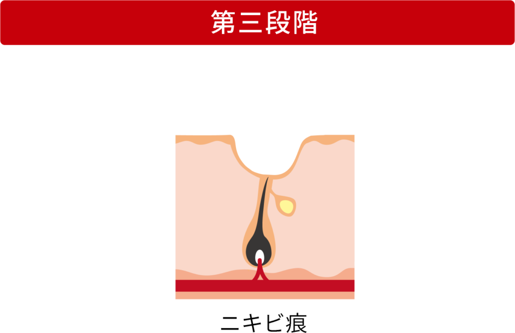 ニキビの進行の第三段階