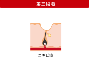 ニキビの進行の第二段階〜第三段階