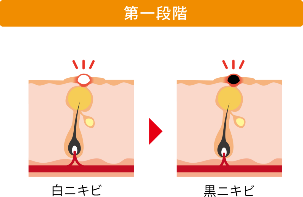 ニキビの第1段階の図