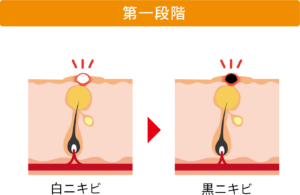 ニキビの進行の初期段階〜第一段階