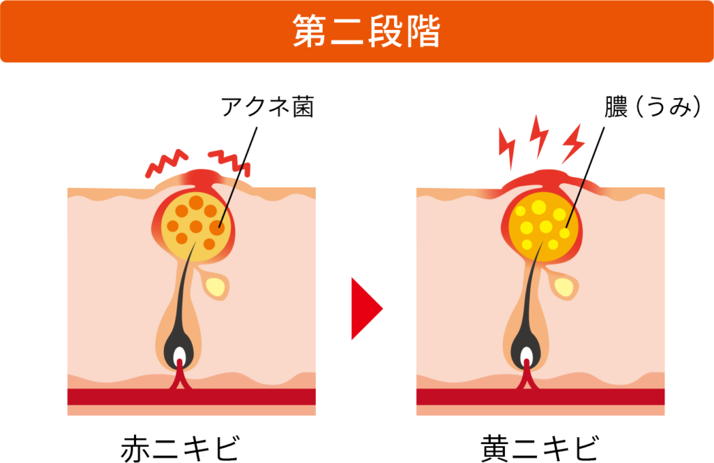 ニキビの第2段階の図
