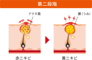 ニキビの進行の第二段階〜第三段階