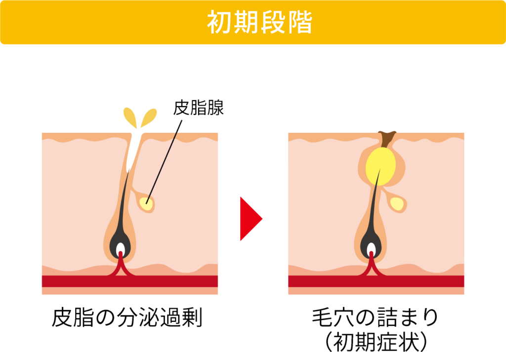 ニキビの進行の初期段階の図