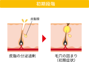ニキビの進行の初期段階〜第一段階