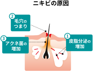 ニキビの原因を表したイラスト