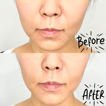 ヒアルロン酸注射によるほうれい線治療のビフォー・アフター