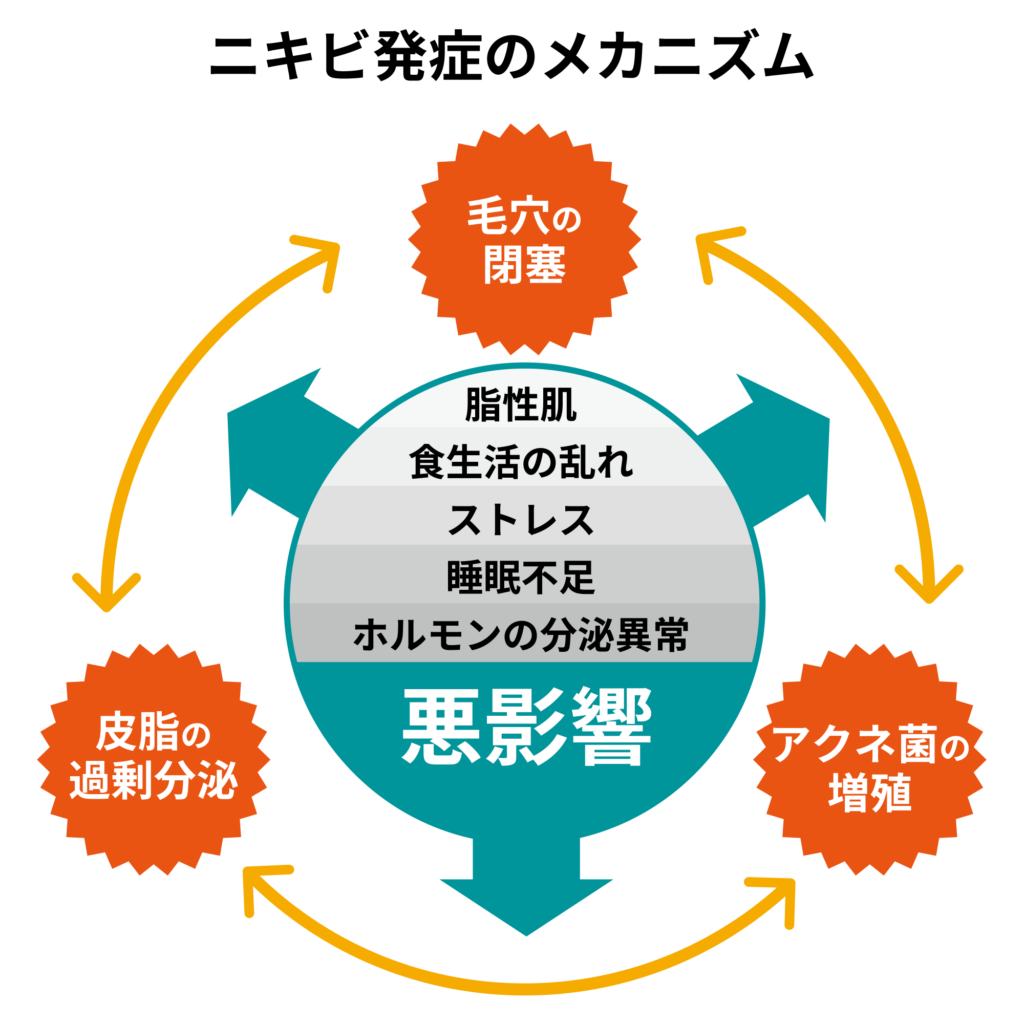 ニキビ発症のメカニズムの図