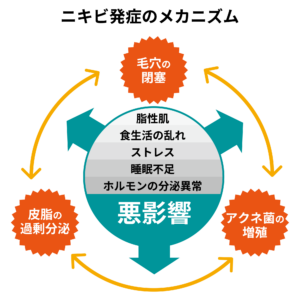 ニキビ発症のメカニズムの図
