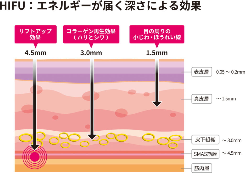 ハイフの図