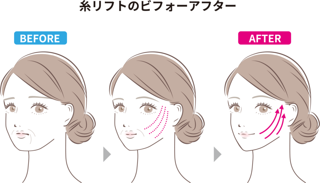 糸リフトのビフォーアフターの図