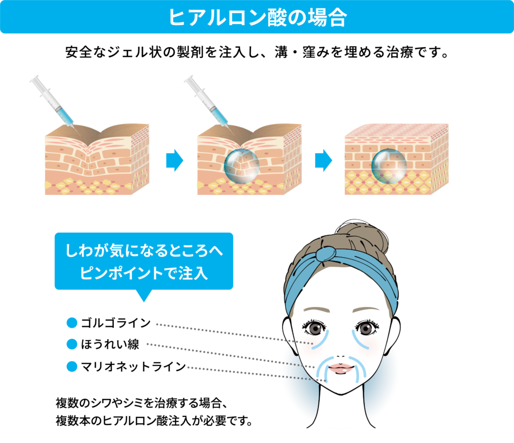 ヒアルロン酸注射の図
