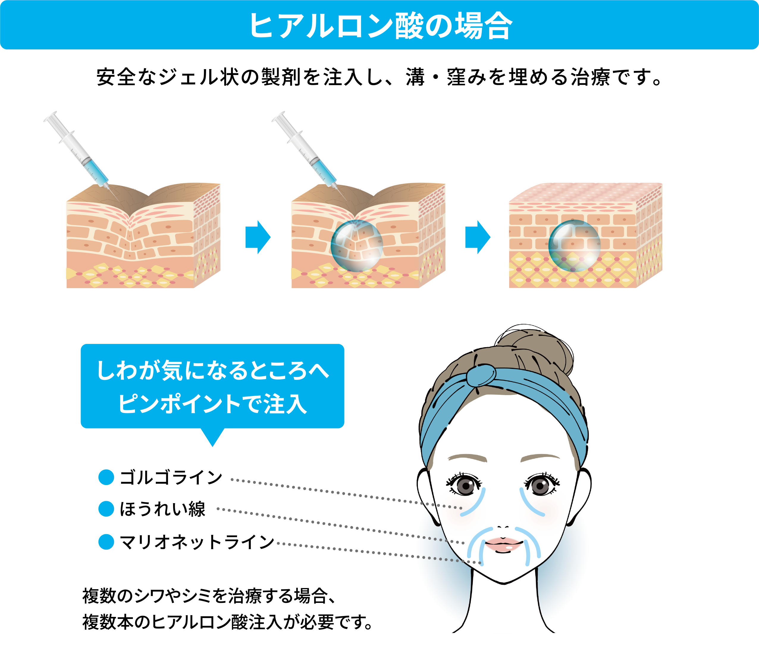 ヒアルロン酸注射による目の下のたるみ治療