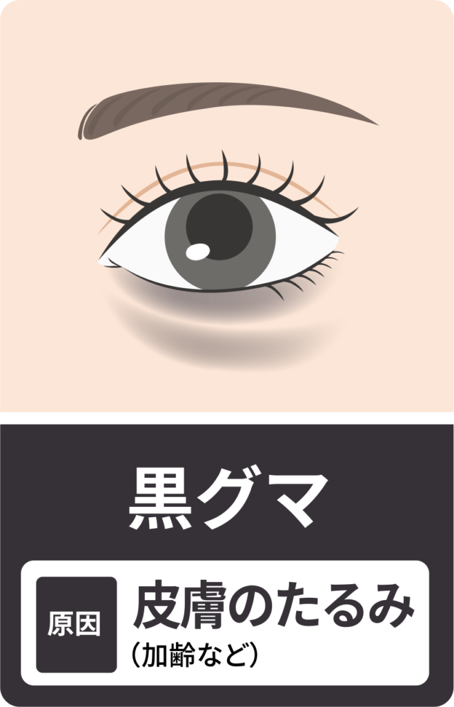 目の下のたるみが原因の黒クマ