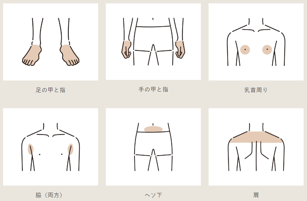 オーシャンズの体脱毛Sパーツ