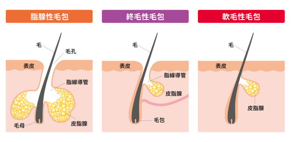 毛包の種類