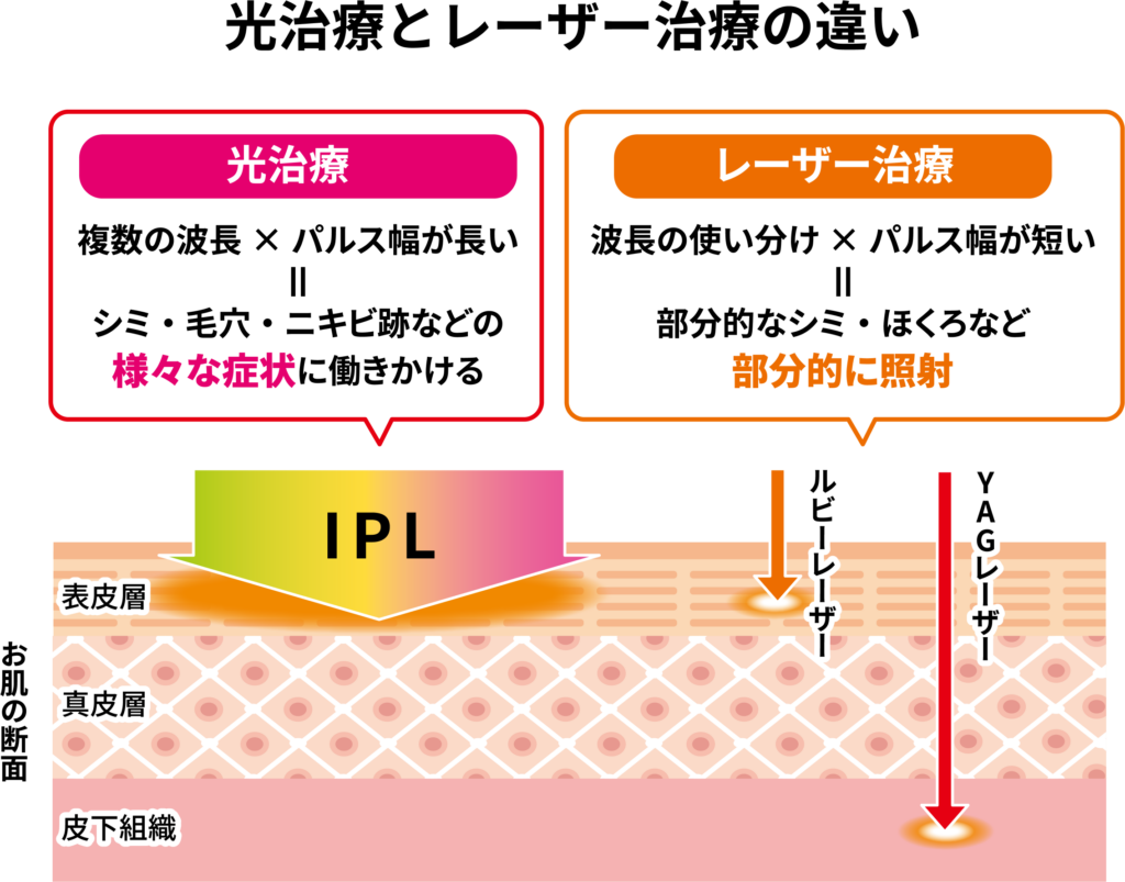 光治療とレーザー治療の違いを表した図