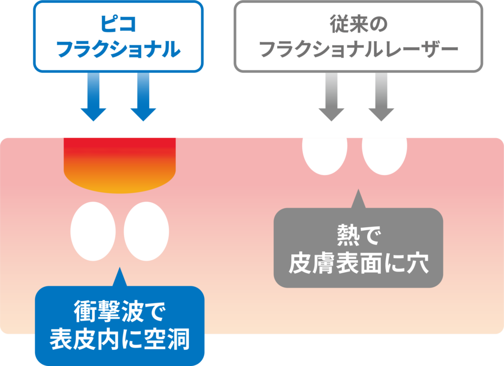 光治療とレーザー治療の違いを表した図
