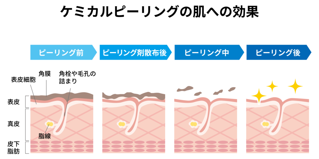 ケミカルピーリングの肌への効果