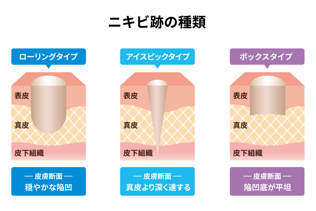 ニキビ跡の種類の図