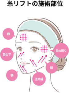 糸リフトの施術部位を示した図