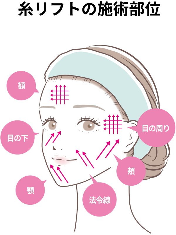 糸リフトの施術部位を示した図