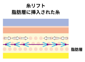 糸リフトで使用する糸の挿入図
