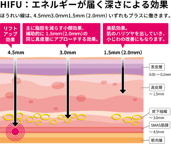 ハイフのエネルギーが届く深さと効果を示した図
