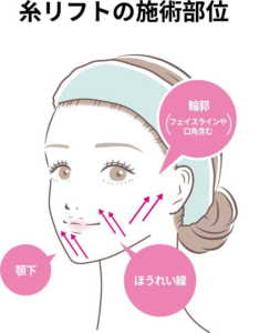 糸リフトの施術部位を示した図