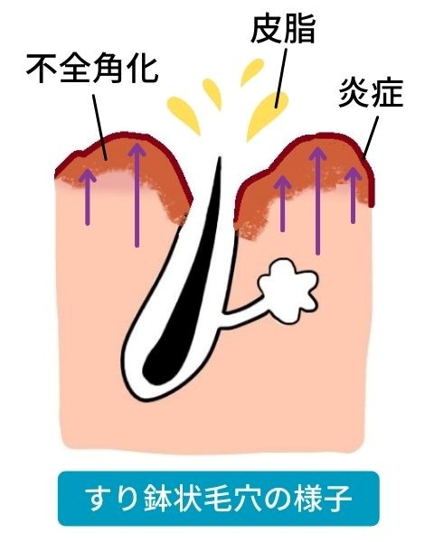 過酸化脂質を増やさないためにもクレンジングが大切