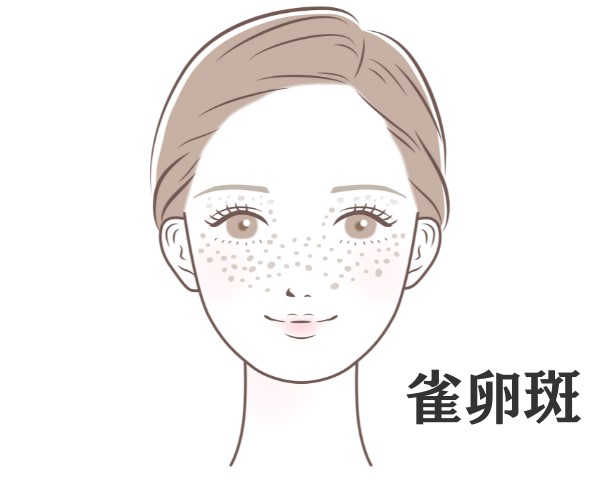 そばかす(雀卵斑)