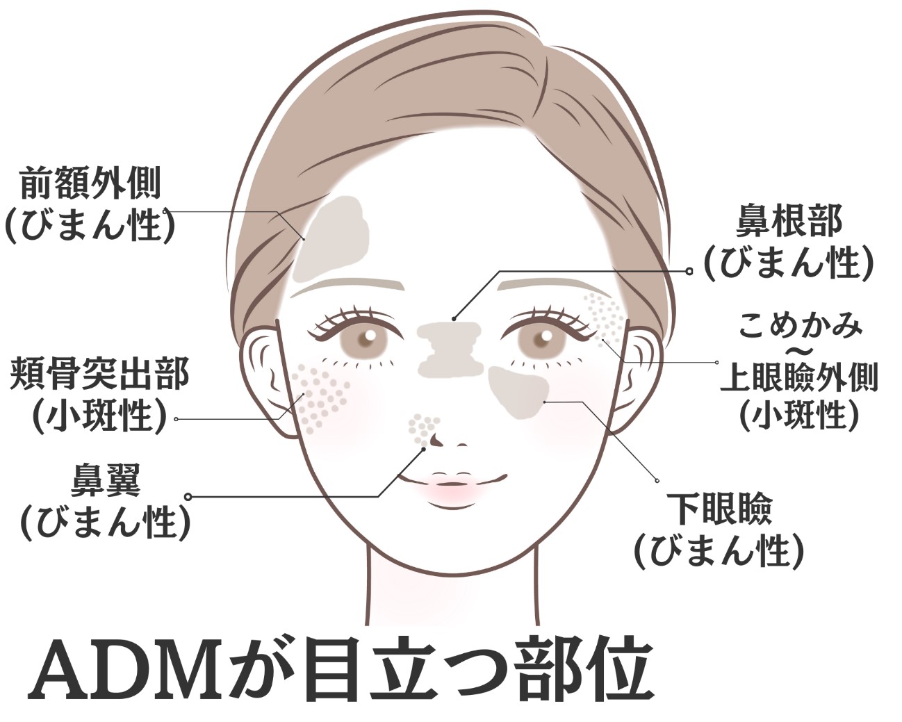 ADMが目立つ部位