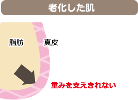 老化した肌：重みを支えきれない