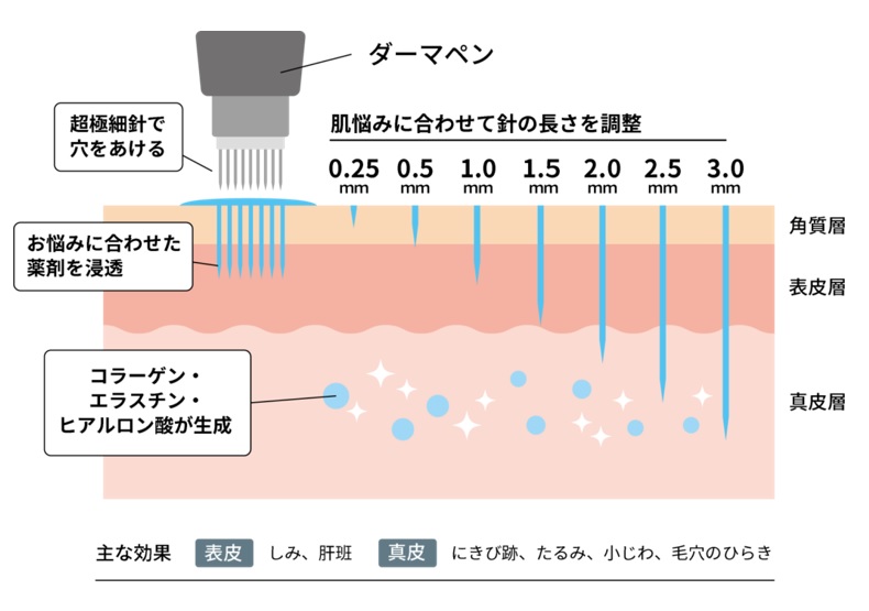 ダーマペンの効果と針の長さ