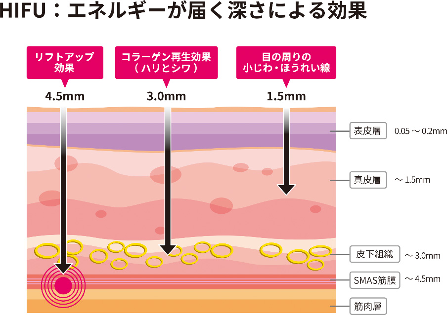  HIFU（ハイフ）の効果を示した図