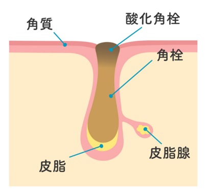 角栓による毛穴の黒ずみの図