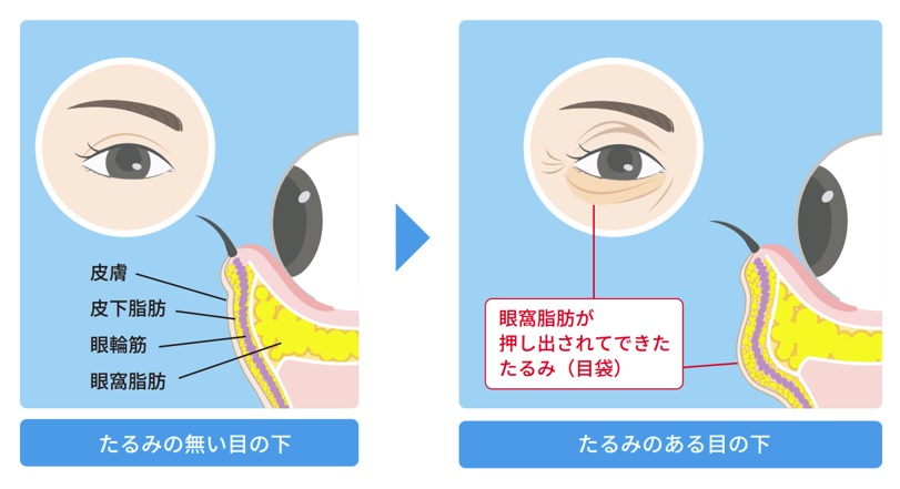 たるみのない目の下とたるみのある目の下を表した図