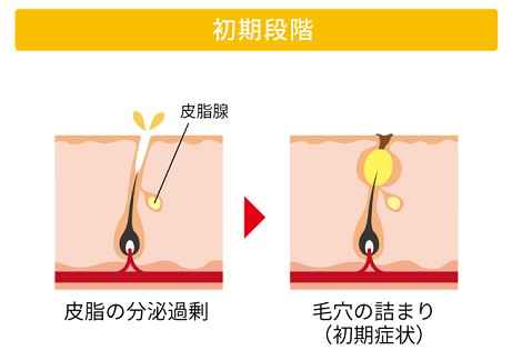 大人ニキビの初期段階