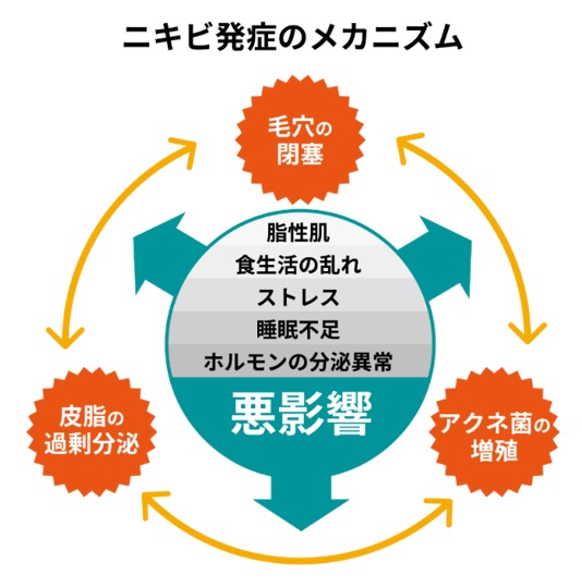 ニキビ発症のメカニズム