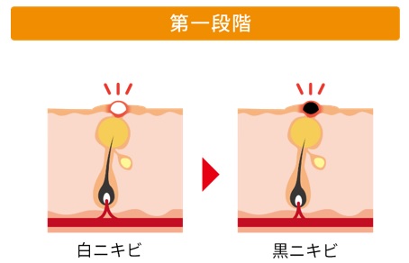 ニキビ発症の第一段階