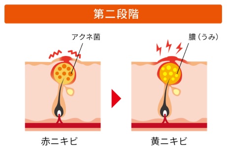 ニキビ発症の第二段階